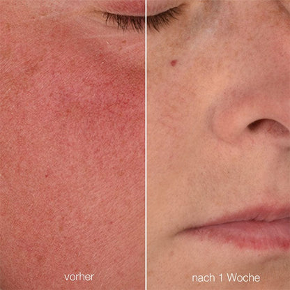 Vergleich zweier Nahaufnahmen einer Gesichtshälfte, links mit Hautrötungen und rechts Verbesserung der Haut nach einer Woche, mit den Unterschriften "vorher" und "nach 1 Woche".